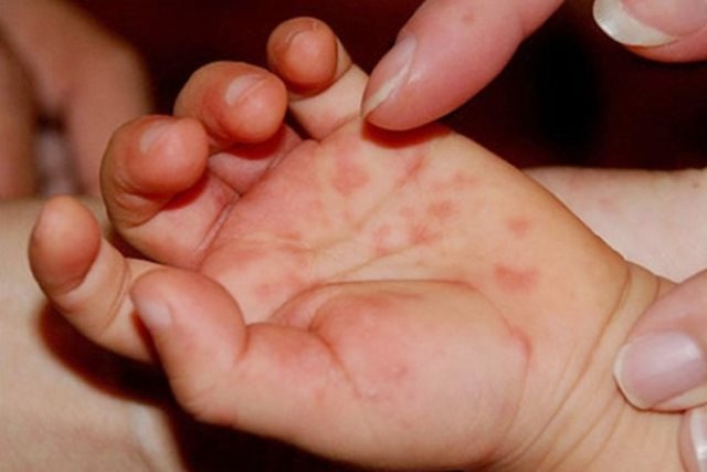 Bệnh tay chân miệng: khi nào chăm sóc trẻ tại nhà, khi nào cần đến viện gấp?